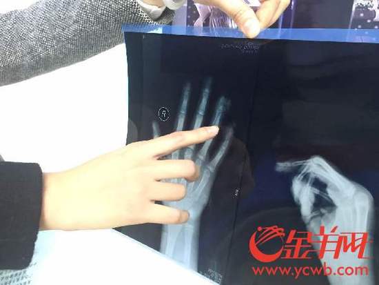 小區(qū)健身器材夾手指？有小孩指骨被夾斷裂 