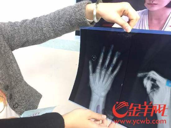 小區(qū)健身器材夾手指？有小孩指骨被夾斷裂 